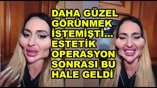 Daha güzel görünmek için girdiği estetik operasyonlar sonrası bu hale geldi [upl. by Forrer]