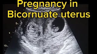 pregnancy in bicornuate uterus ultrasound case [upl. by Derr687]