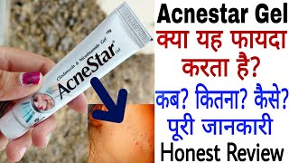 Acnestar Gel Review  Acnestar Gel Kaise Use Kare  Acnestar Gel Ke Fayde [upl. by Ainimreh]