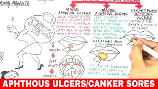 Aphthous Ulcers  Canker Sores  Pathophysiology Triggers Types amp Treatment [upl. by Hillinck]