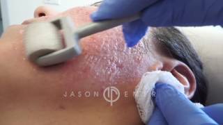 Dermaroller  Microneedling Acne Scars  Skin Resurfacing  Los Angeles California [upl. by Novla]