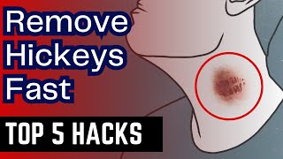 How to Remove HICKEYS Fast  5 Proven Methods That Work  Get Rid of Hickey Quickly [upl. by Einad]