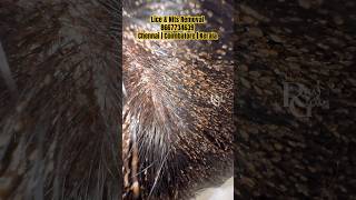 How to remove nits from hairlice removallice removal Treatment in Parlourhow to prevent lice [upl. by Stimson883]