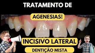 Tratamento de AGENESIA DE INCISIVO LATERAL substituído pelo canino permanente  Aula 147 [upl. by Eremahs]