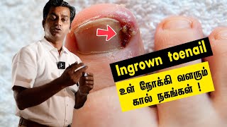 Ingrown toenail Causes  Treatment  கால் கட்டை விரல் நகம் வலி [upl. by Ellemac815]