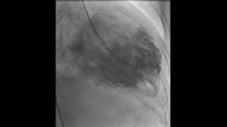 HAKIMVISTA MIOCARDIOPATIA DILATADA VENTRICULOGRAMA CON TROMBO INTRAVENTRICULAR [upl. by Gaston]