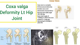 coxa valga deformity in left hip joint [upl. by Roddie642]