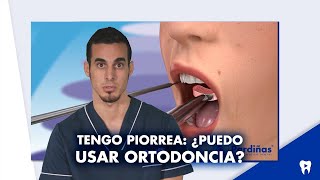 ¿Puedo ponerme ORTODONCIA si tengo PERIODONTITIS o me FALTAN DIENTES  Shorts [upl. by Hnid]