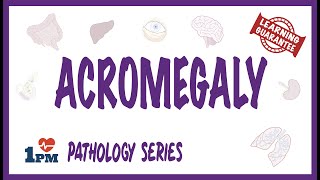 Acromegaly  Pathophysiology Symptoms Diagnosis Treatment [upl. by Anoli407]