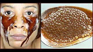 REMOVE DARK CIRCLES EYES BAGS PUFFY EYES  WRINKLES 100 EFFECTIVE Khichi Beauty [upl. by Ishmael442]