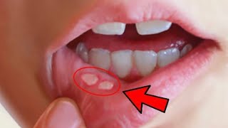 Canker sore  how to get rid of canker sores fast inside your mouth [upl. by Rochkind389]