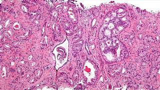 Prostate Cancer Biopsy What Biopsy Detects For Prostate Cancer [upl. by Neidhardt]