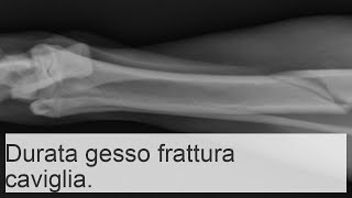 Frattura della caviglia con e senza spostamento quanto tempo bisogna camminare con il gesso [upl. by Kurr]