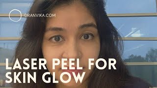 Laser peel for skin glow  best skin glow treatment dranvikacom [upl. by Siramay]