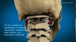 C1 and C2 Atlantoaxial Instability Upper Cervical Instability and Prolotherapy animation [upl. by Eniamart]