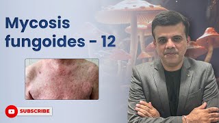 Histology of Mycosis Fungoides vs Sézary Syndrome Key Features Explained  Dr Sashikant Adlakha [upl. by Aileahcim325]