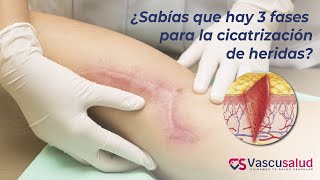 ¿Sabías qué hay 3 fases de cicatrización para las heridas  Vascusalud [upl. by Kanya186]