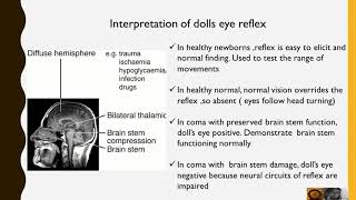 Dolls eye Reflex [upl. by Yelreveb]