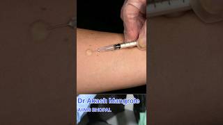 Mantoux Test  Tuberculin Skin Test doctor aiims neet academic mbbsmotivation [upl. by Ulland]