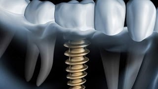 Welches Zahnimplantat System ist das beste [upl. by Ydnih]