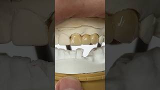 Anterior Monet Pure Zirconia Bridge dental teeth smile lsk121shorts shortvideo shorts [upl. by Yekcor]