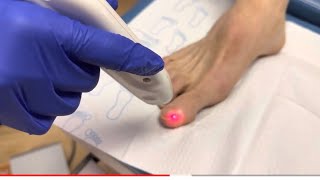 Lunula Laser  Toenail Fungus Therapy [upl. by Rochester41]