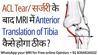 ACL Tear सर्जरी के बाद Anterior Translation of Tibia कैसे होगा ठीक  Bio ACL Surgery Bone Grafting [upl. by Yejus]