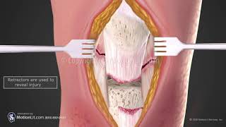 Patella Tendon Repair [upl. by Gregory433]