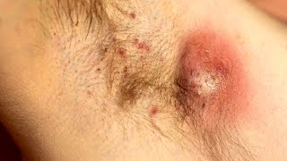 Hidradenitis Suppurativa  Acne Inversa [upl. by Aramad599]