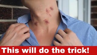 How to Get Rid of Hickeys  11 Proven Methods to Clear Your Skin Quickly [upl. by Aneekal]