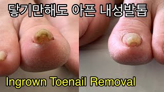 신발도 못신었던 내성발톱 치료 amp고랑이 대청소 Ingrown toenail removal [upl. by Asiral]