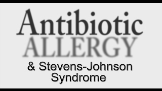 3 Errors Causing AntiBiotic Allergy amp StevensJohnson Syndrome [upl. by Etnovad447]