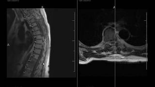 How to differentiate Degenerative disk disease and spinal infection [upl. by Klug525]