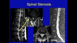 UCSF Radiology Spinal Stenosis [upl. by Alliuqal]