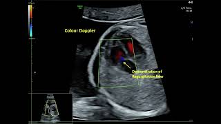 Trivial Tricuspid Valve Regurgitation  Fetal Echo [upl. by Arima809]