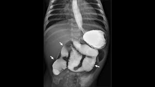 BARIUM MEAL procedure By ZAMZAM DIGITAL XRAY CENTER MIANWALI [upl. by Laux]