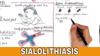 Sialolithiasis  Salivary Stones  Pathogenesis Clinical features amp Treatment [upl. by Moise100]