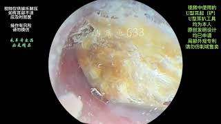 采耳哥The ear canal is blocked by large pieces of fungal earwax for cleaning [upl. by Adnilemreh674]