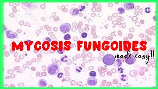 Mycosis Fungoides  WBC disorders  Sezary Syndrome [upl. by Luci]