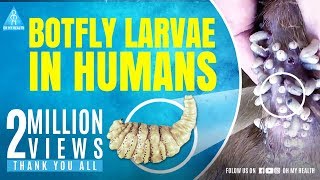 botfly larvae in humans [upl. by Luce148]