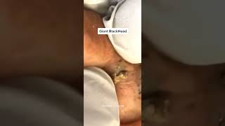 Blackheads Removal  Acne Treatment and Very Satisfying Satisfying Pimple pop blackheads [upl. by Ataliah]