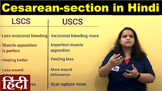 Cesarean delivery in Hindi  CSection  Nursing Lecture [upl. by Aken]