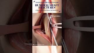 Innovative Treatment for Humerus Fracture medical shorts tech suture science animation learn [upl. by Garnes]