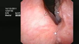 Cancer of the larynx voicebox  wwwdrjeevecom [upl. by Tabatha]