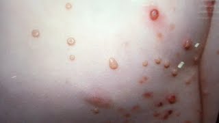 Molluscum Contagiosum PopTALK Dermatology diagnosis discussion [upl. by Dibri]