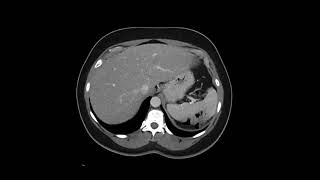 Retroperitoneal Leiomyosarcoma [upl. by Ailad]