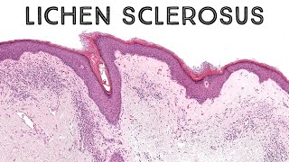 Lichen sclerosus with epidermotropism mimic of mycosis fungoides pathology dermatology dermpath [upl. by Tori]