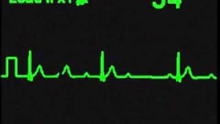 2nd Degree Type I AV Block  ECG Simulator  Arrhythmia Simulator [upl. by Brower]