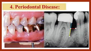 5 Periodontal Disease after Fixed Prosthodontics امراض دواعم السن بعد التركيبات [upl. by Harahs]