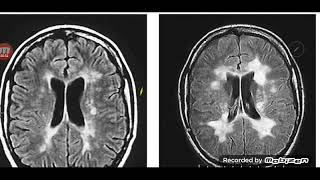 CNS degenerative diseases [upl. by Mart]